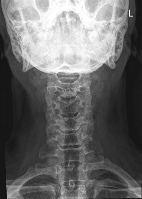 x ray for cervical spondylosis